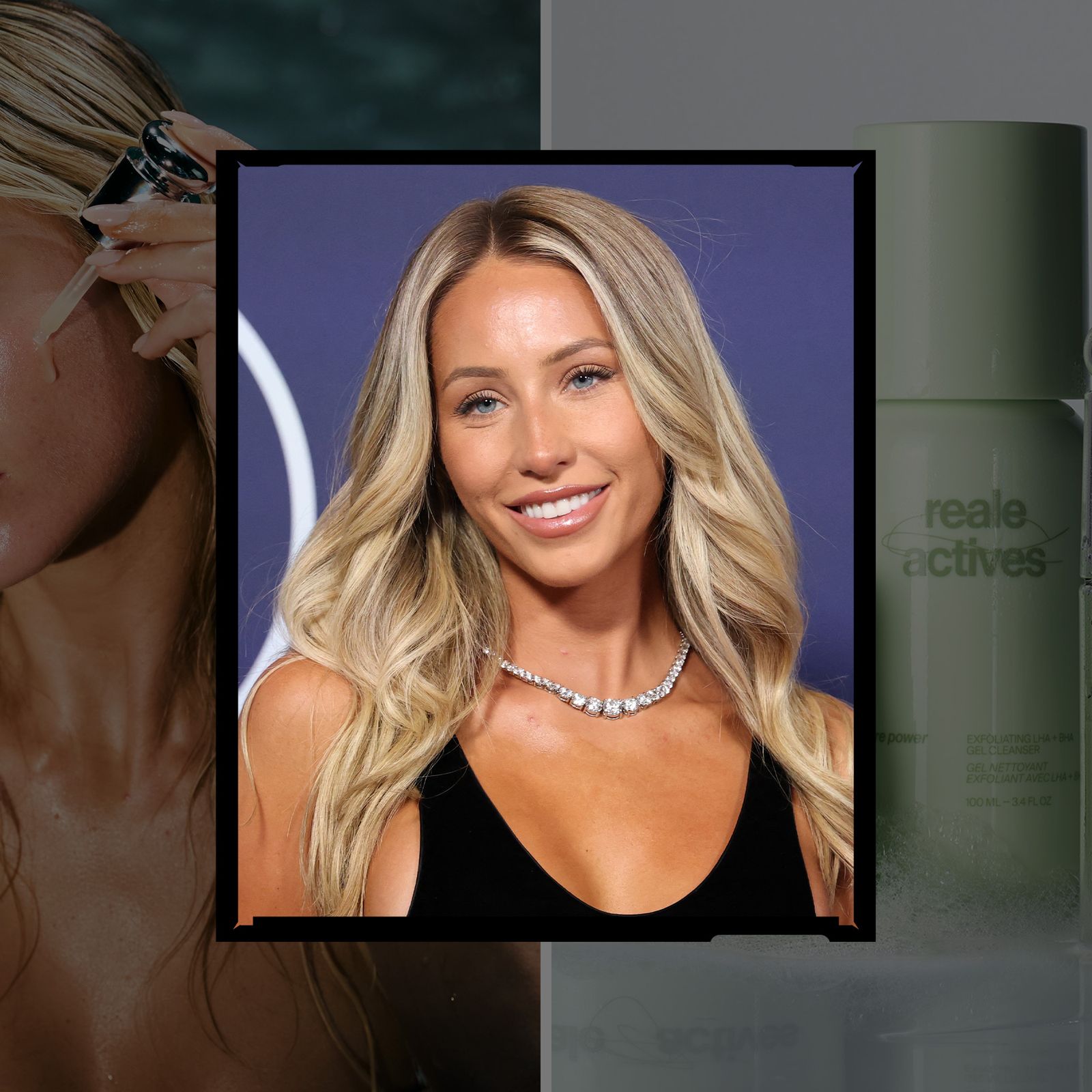 Alix Earle Wants to Make Acne "Sexy and Hot"
