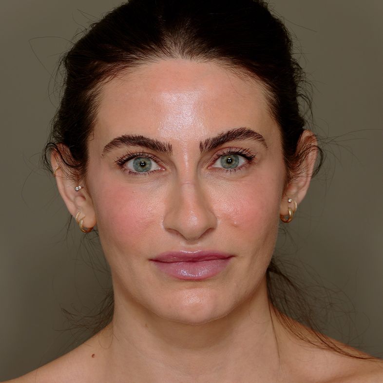 I Tried Facial Fat Grafting—Here's How I Feel About My Results 2 Years Later