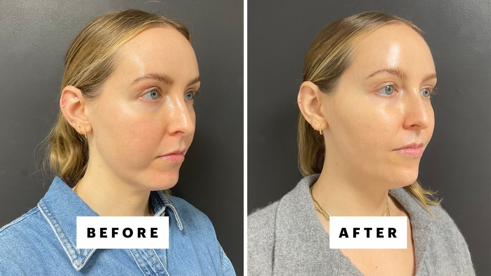 side by side before and after photos of woman with chin filler