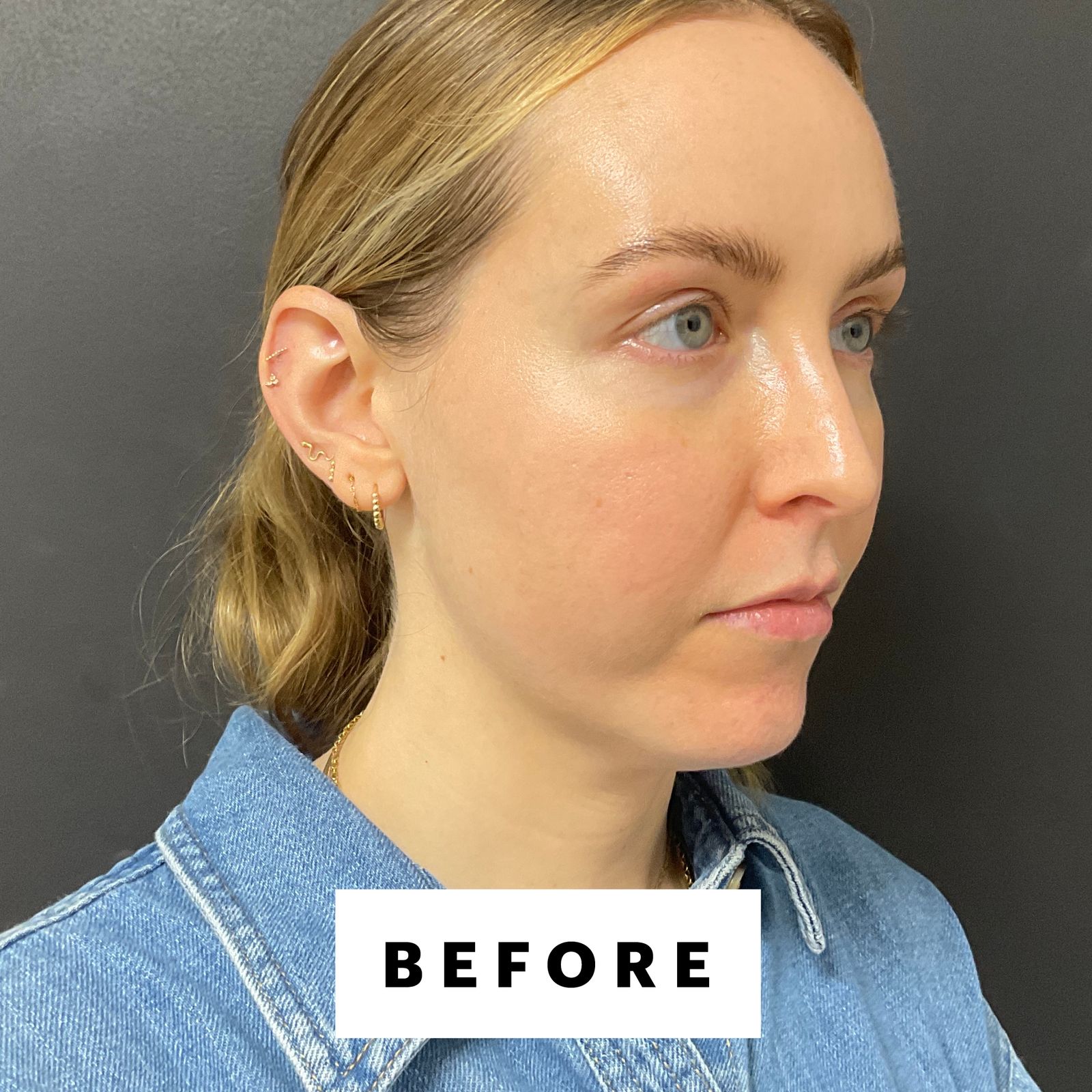 I Got Chin Filler for My "Weak" Chin