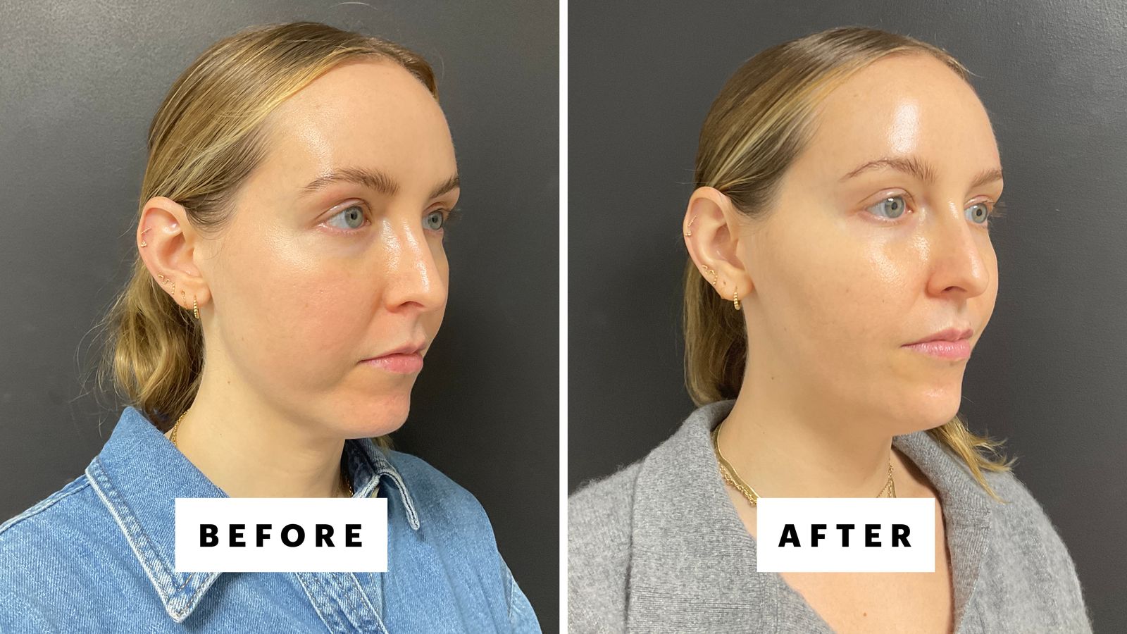 I Got Chin Filler for My "Weak" Chin