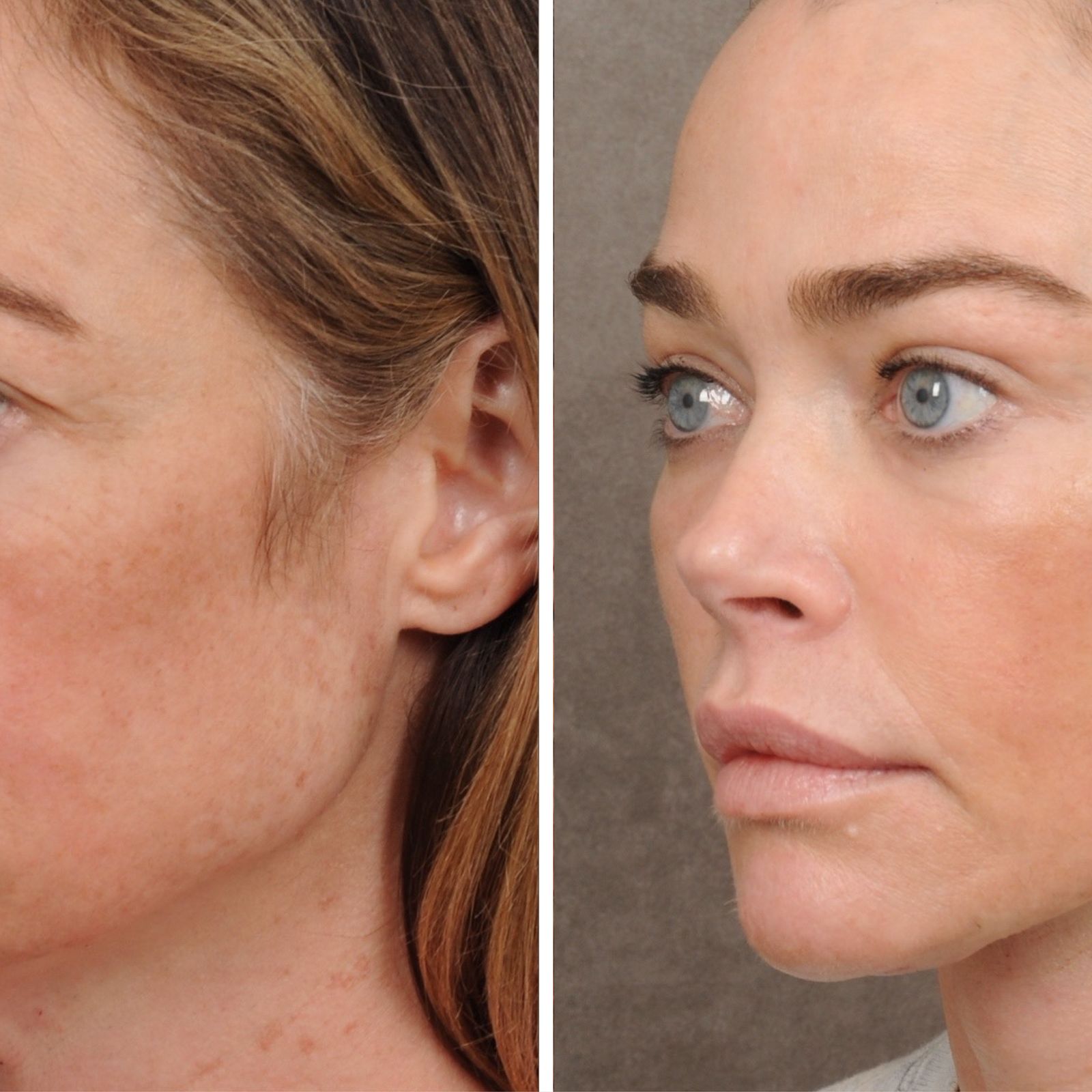 Denise Richards Opens Up About Her Facelift