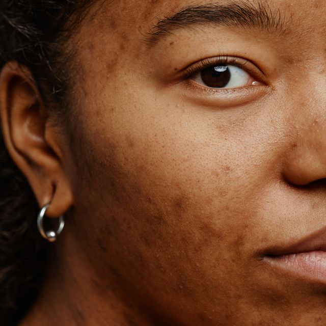 3 Best Dark Spot Correctors That Will Transform Your Skin