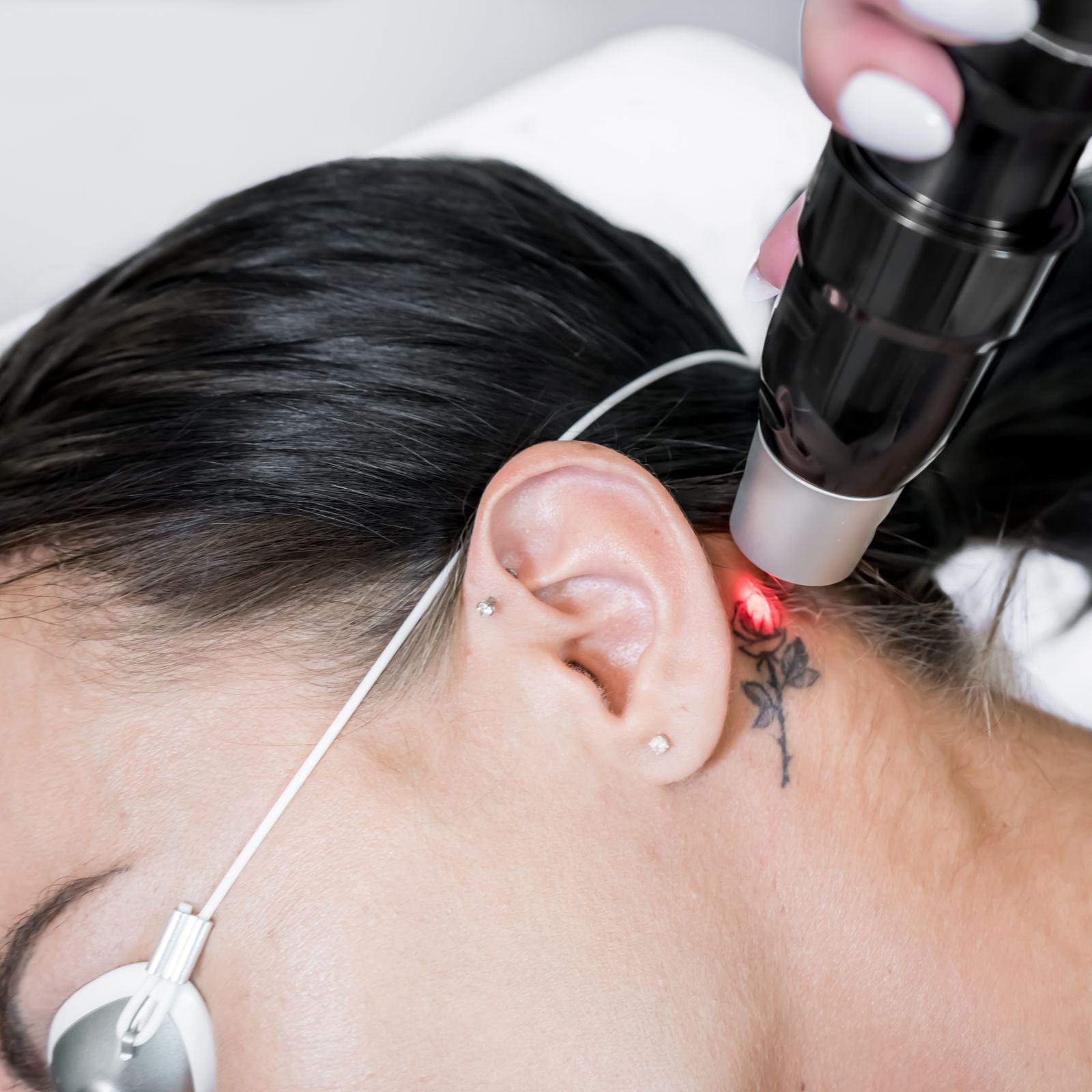I Got Laser Tattoo Removal Treatments to Erase a Memory of My Ex