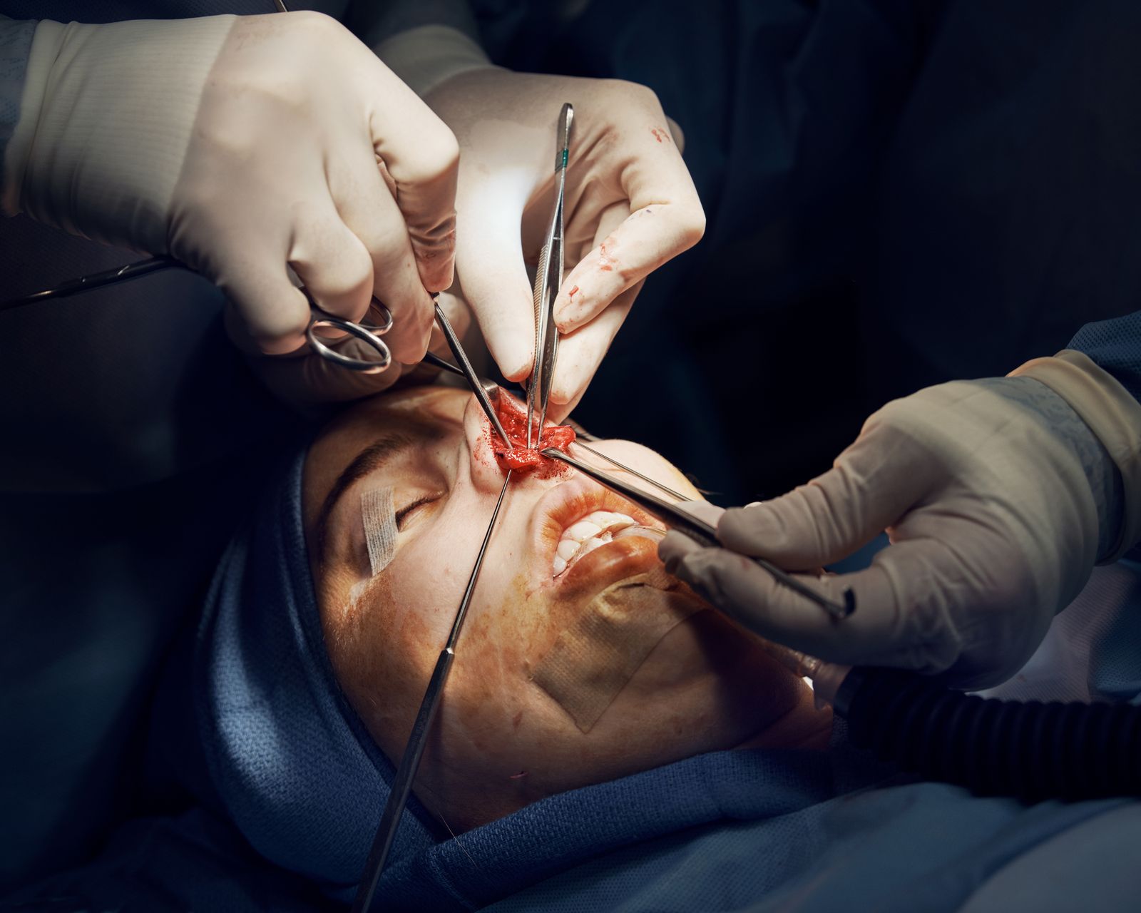 rhinoplasty process photos for allure.com's life in plastic column