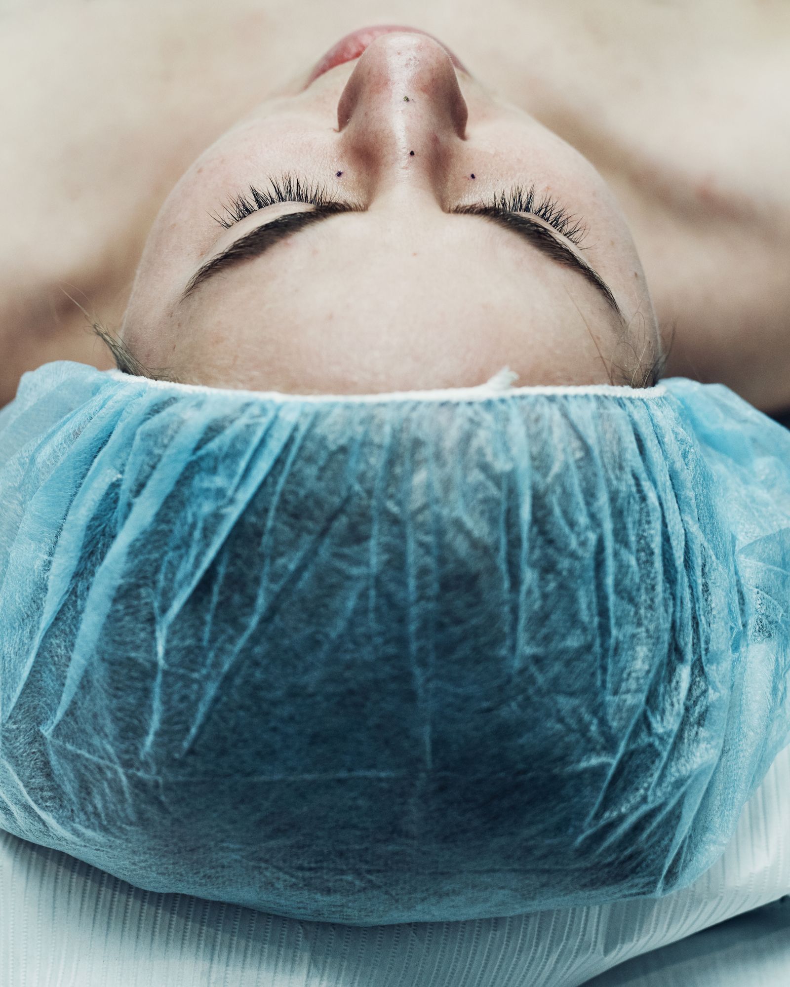rhinoplasty process photos for allure.com's life in plastic column